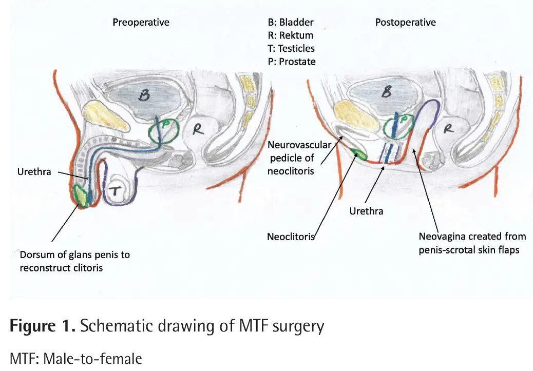 Genital Reconstruction in Male to Female Surgery