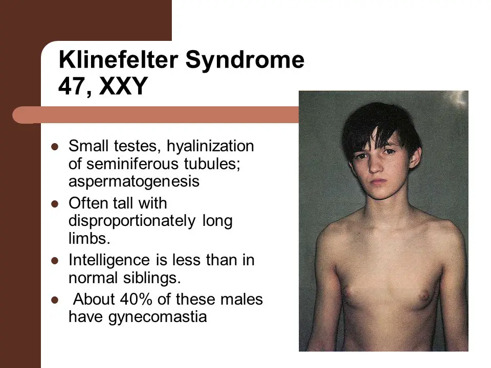 Klinefelter syndrome