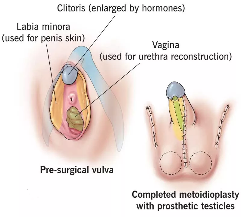 Metoidioplasty