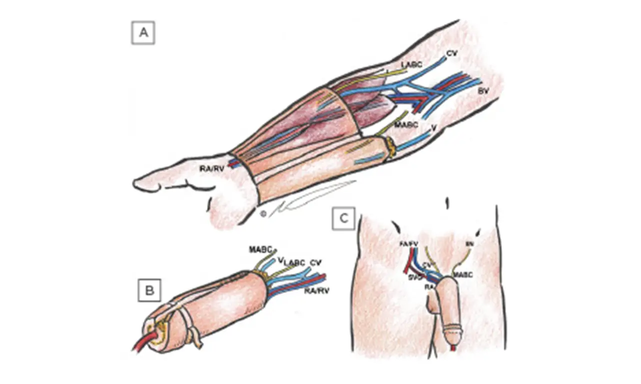 Phalloplasty