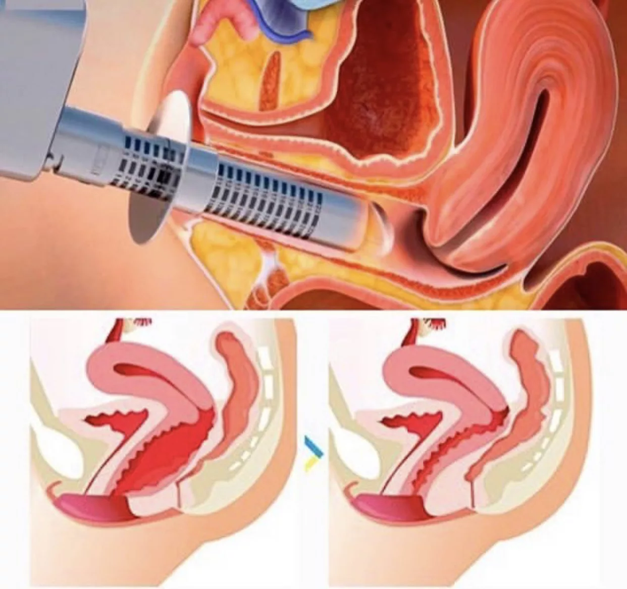 Vaginoplasty